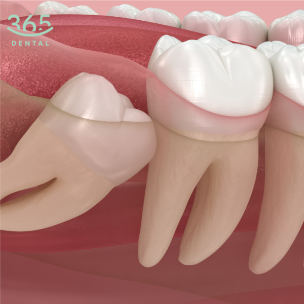 Nhổ răng khôn độ khó 2 tại Dental 365