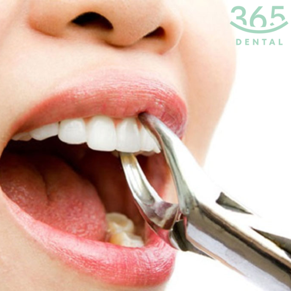 Nhổ răng cửa độ khó 1