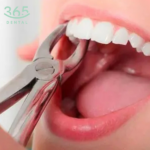 Nhổ răng hàm lớn độ khó 1