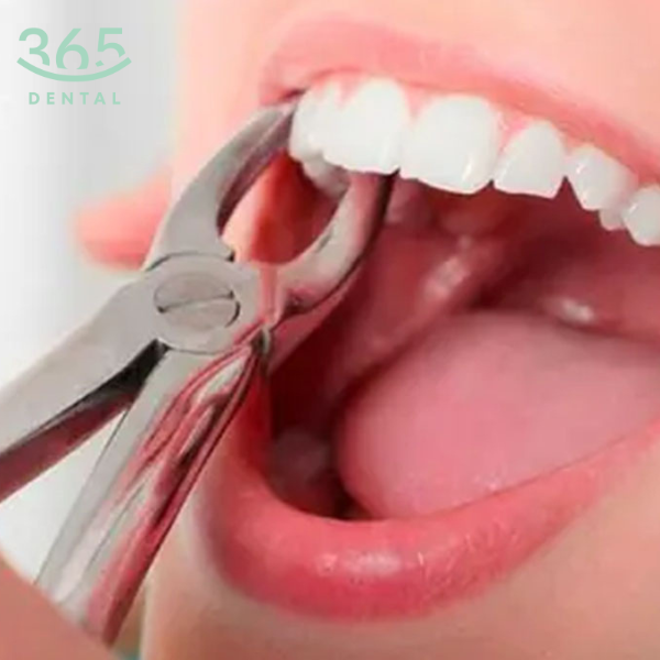 Nhổ răng hàm lớn độ khó 1