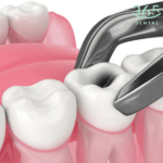 Nhổ răng hàm thỏ độ khó 2