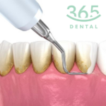 Lấy cao răng độ khó 1