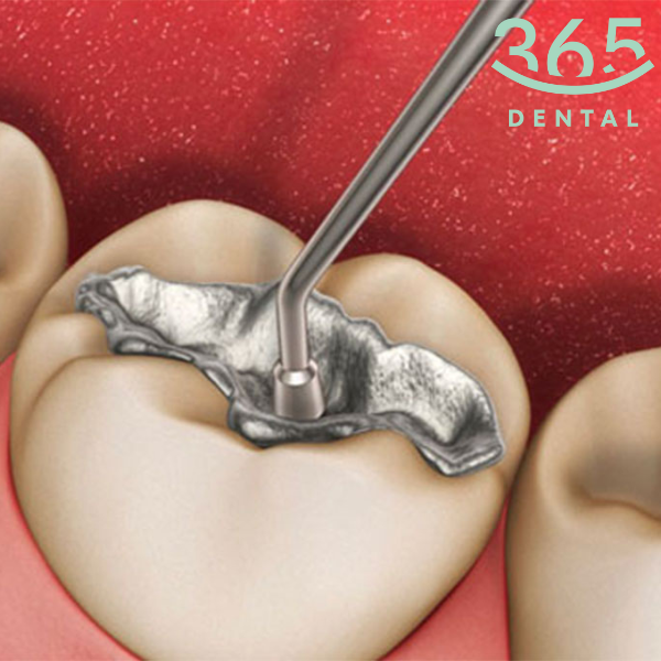 Hàn răng vĩnh viễn