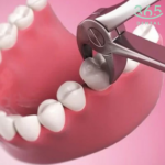 Nhổ răng thỏ cấp độ 1