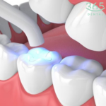 Hàn răng thẩm mỹ