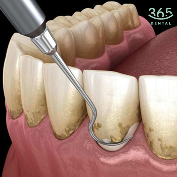Lấy cao răng cấp độ 2