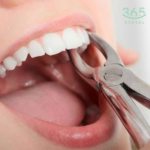 nhổ răng cửa độ khó 2