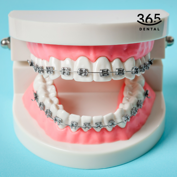 Level 1 Bracket Braces