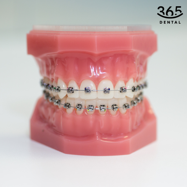 niềng răng mắc cài cấp độ 1
