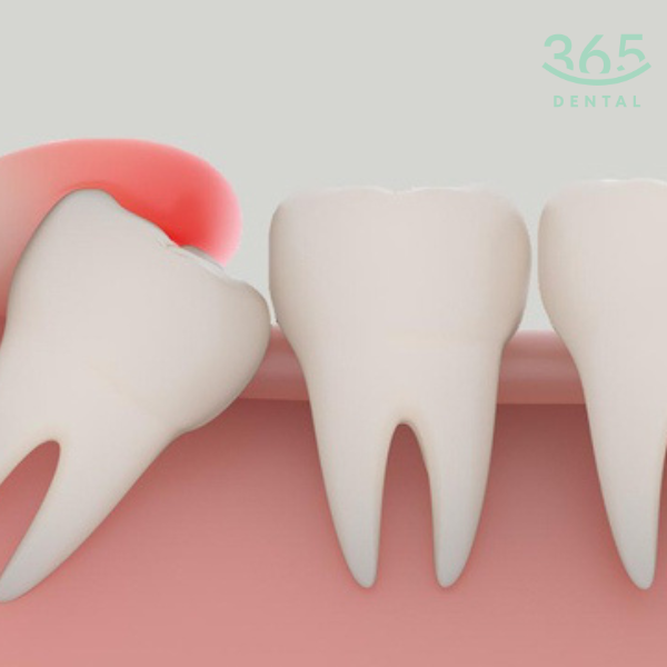 Nhổ răng khôn độ khó 4 tại Dental 365