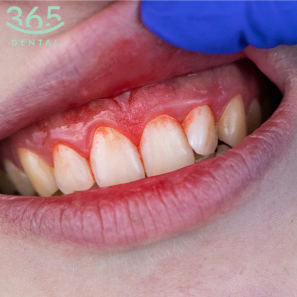 Viêm quanh răng - Dental 365