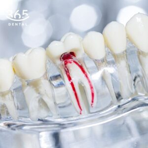 Điều trị tủy răng sữa tại Dental 365