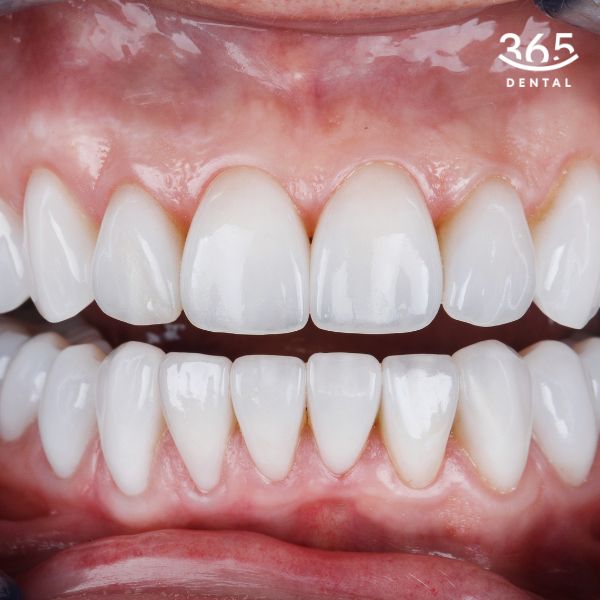 Tại sao nên bọc răng sứ Katana tại Dental 365