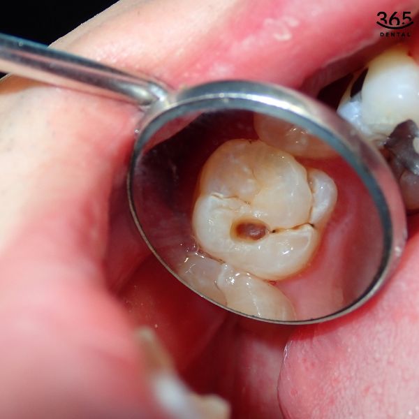 Vì sao mẹ bầu dễ bị sâu răng?