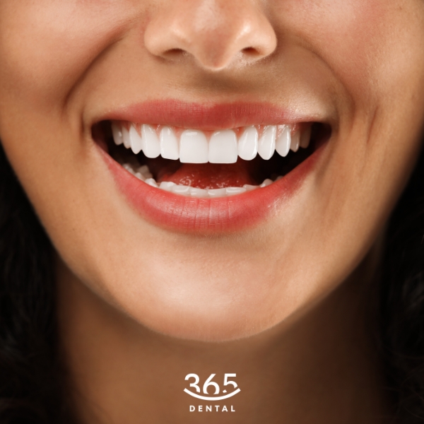 Răng sứ Ht Smile tại Dental 365 có gì đặc biệt?