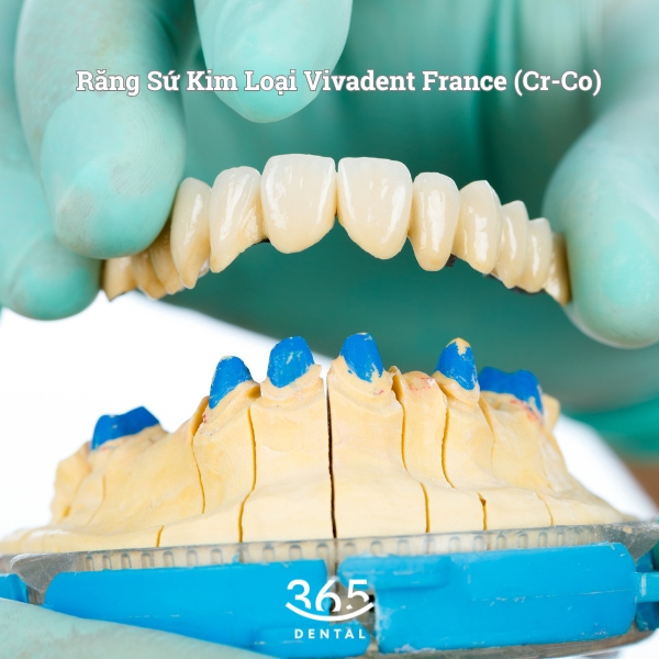 Răng sứ kim loại Vivandent France là gì?