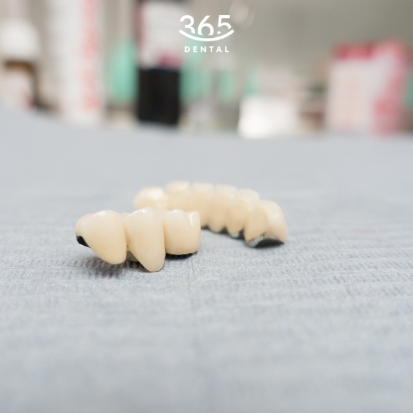 Ưu điểm của răng sứ kim loại thường
