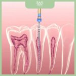 Điều trị tuỷ răng một chân