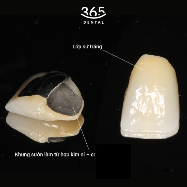 Răng sứ kim loại thường (Ni-Cr)